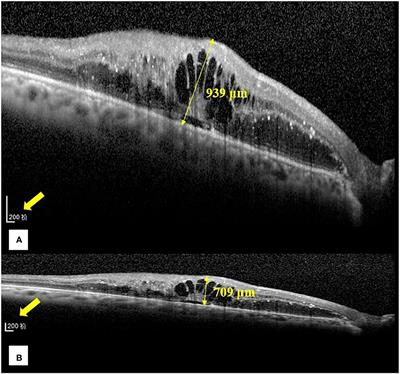 Difference of central foveal thickness measurement in patients with macular edema using optical coherence tomography in different display modes